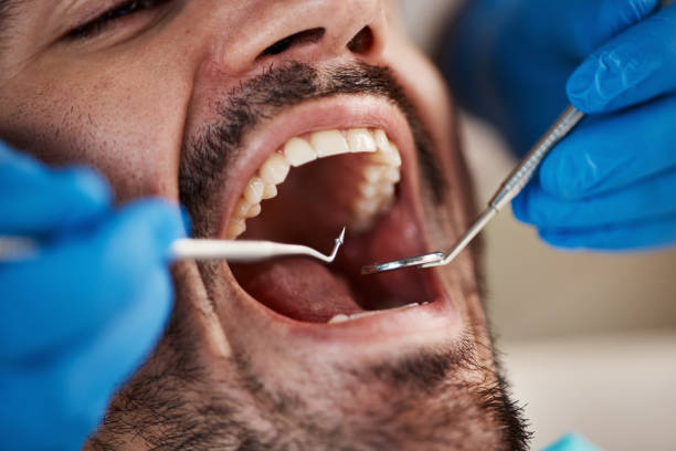 Best Emergency Wisdom Teeth Removal in Oran, MO