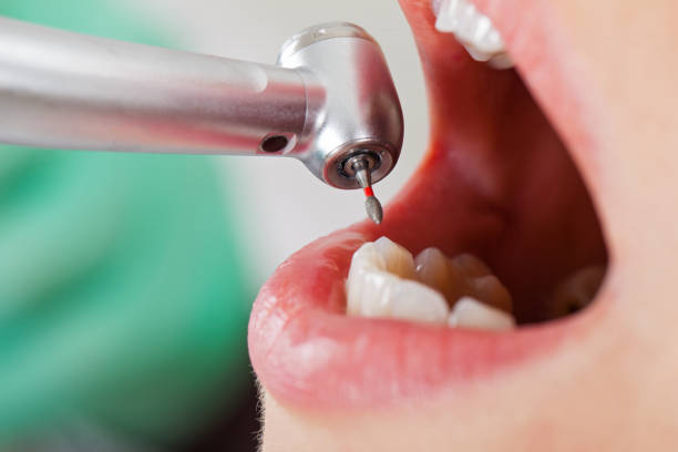 Best Emergency Tooth Extraction in Oran, MO